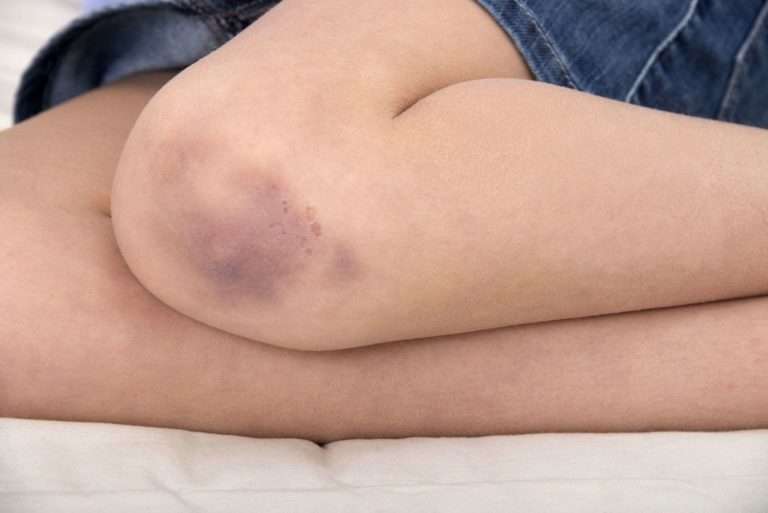 Why Does Alcohol Cause Bruising? Why Does Alcohol Cause Bruising?